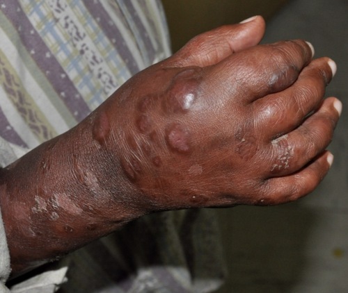 Leprosy More Info